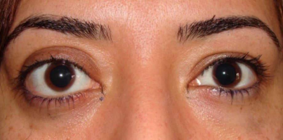 Göz Hastalıkları İle İlgili Bilgiler