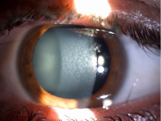 14_Macular type corneal dystrophy