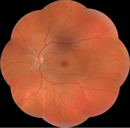 Normal fundus appearance in a healthy eye