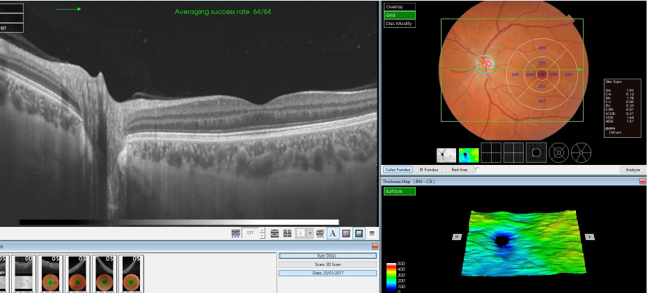 2_OCT OF MACULA AND OPTIC NERVE