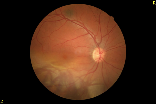 33_RD IN THE INFERIOR HALF OF THE RETINA